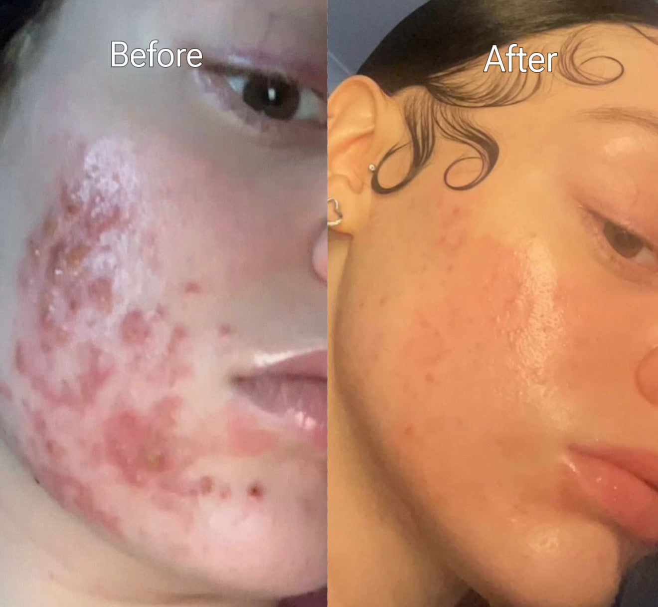 Goodbye Acne Cream