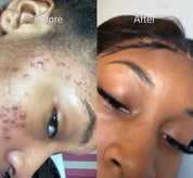 Goodbye Acne Cream