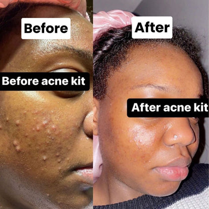 Acne Kit