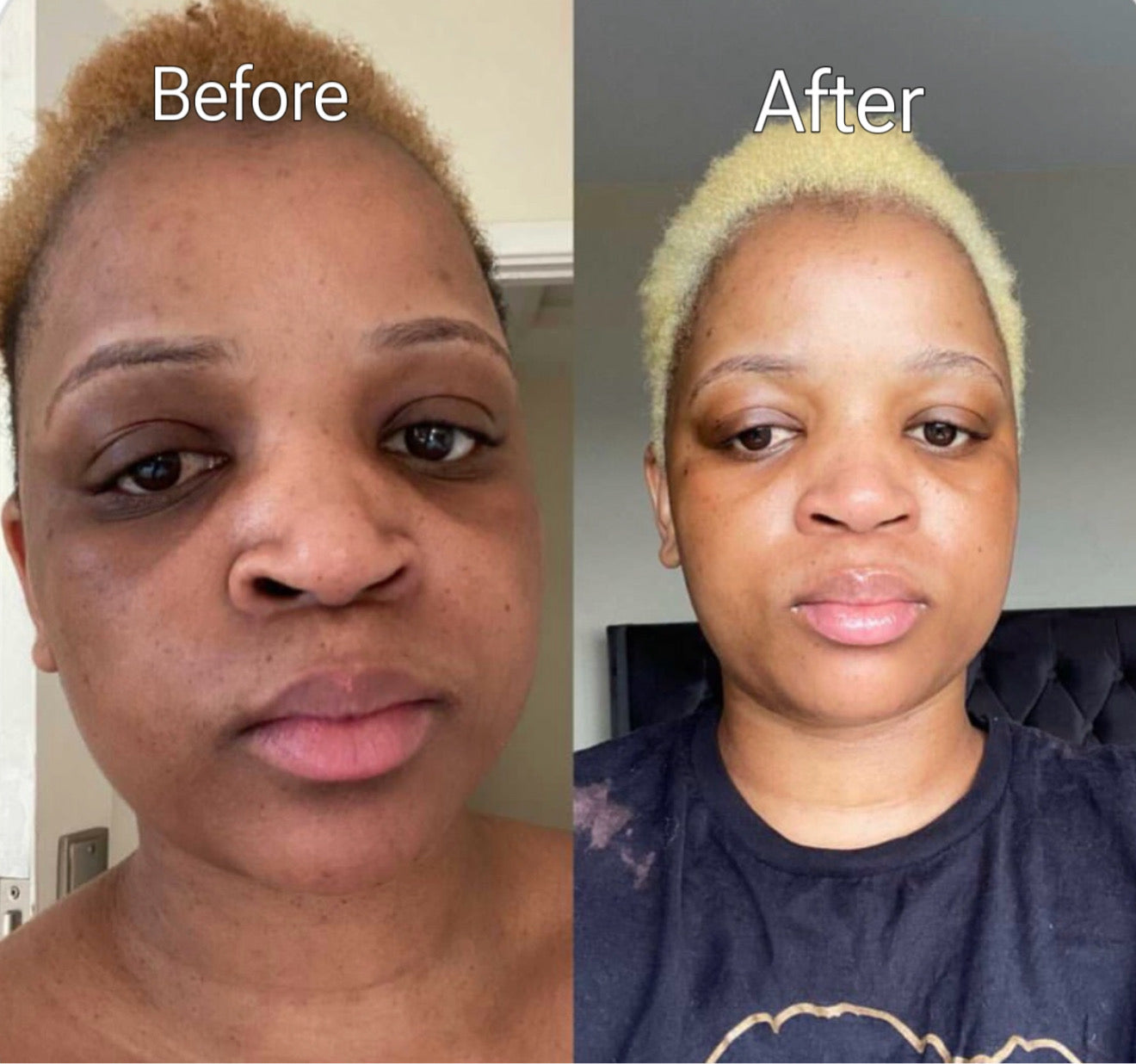 Hyperpigmentation Kit โ Gwenivere Skin