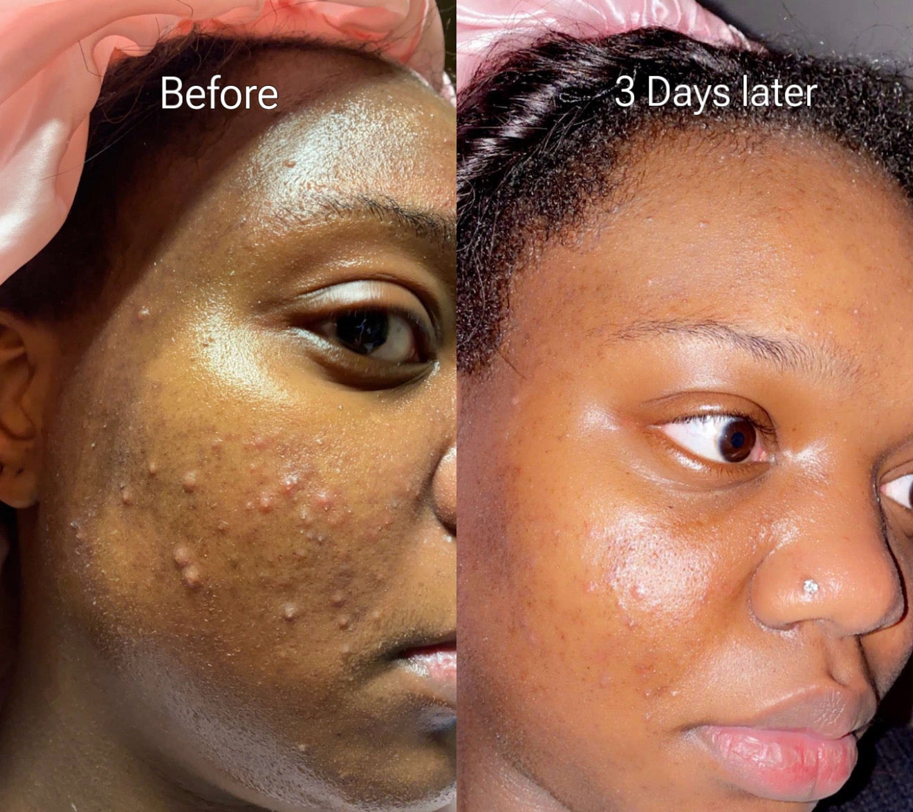 Goodbye Acne Cream