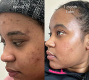 Hyperpigmentation Kit