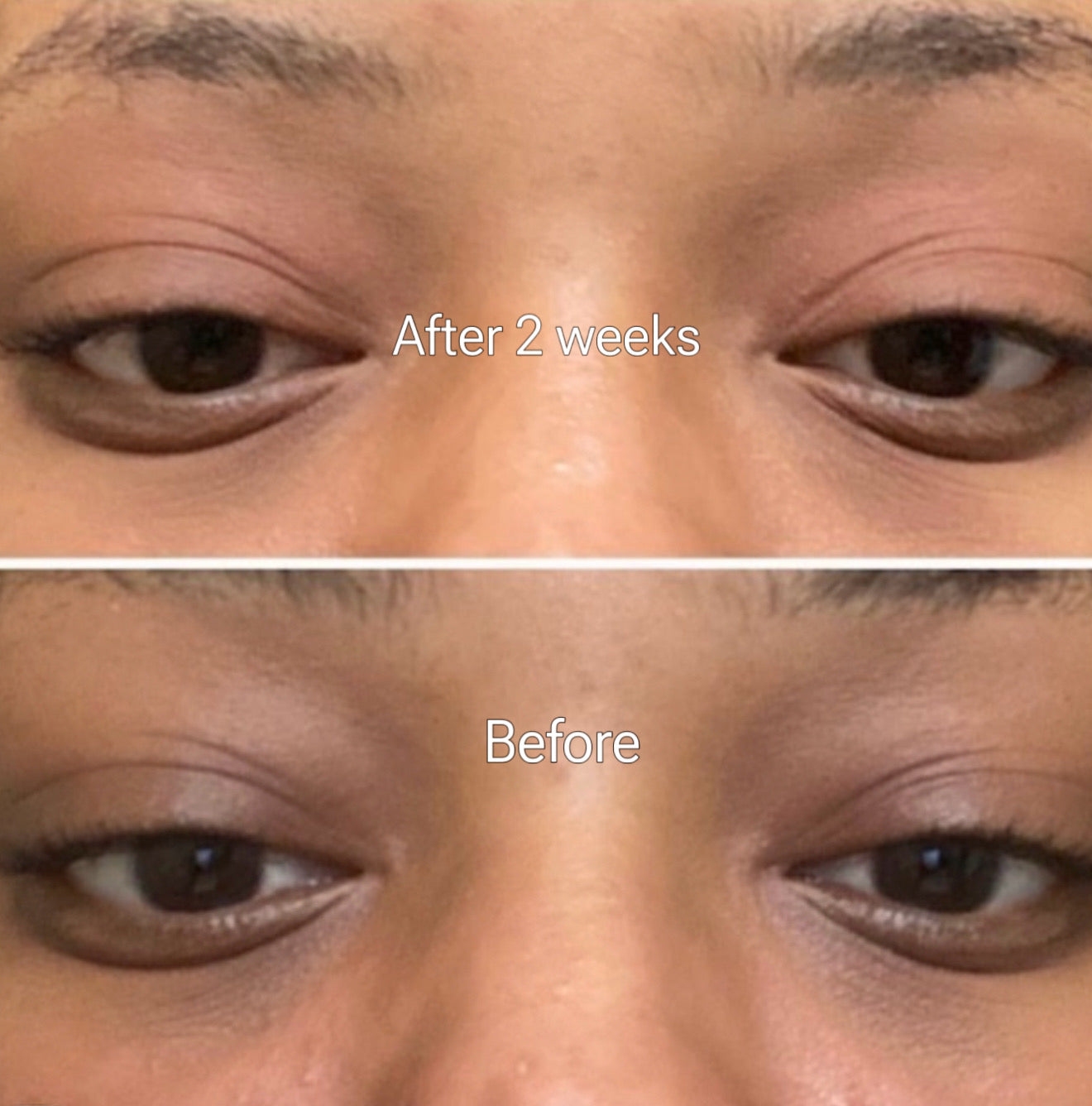 Dark Circle Treatment