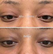 Dark Circle Treatment