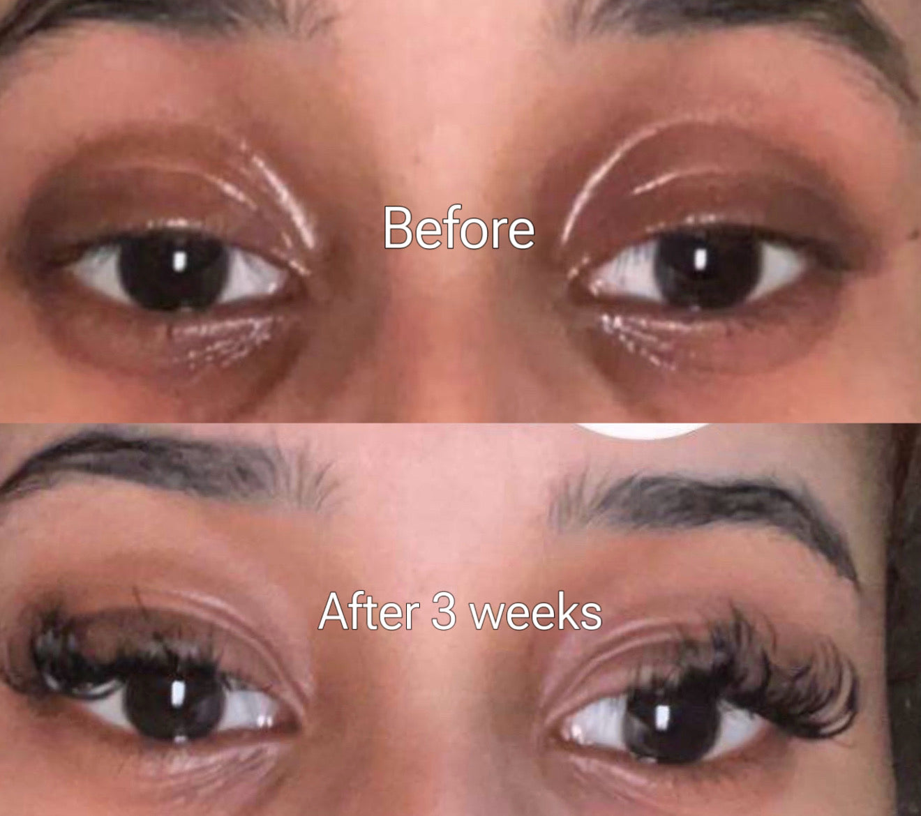 Dark Circle Treatment