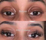 Dark Circle Treatment