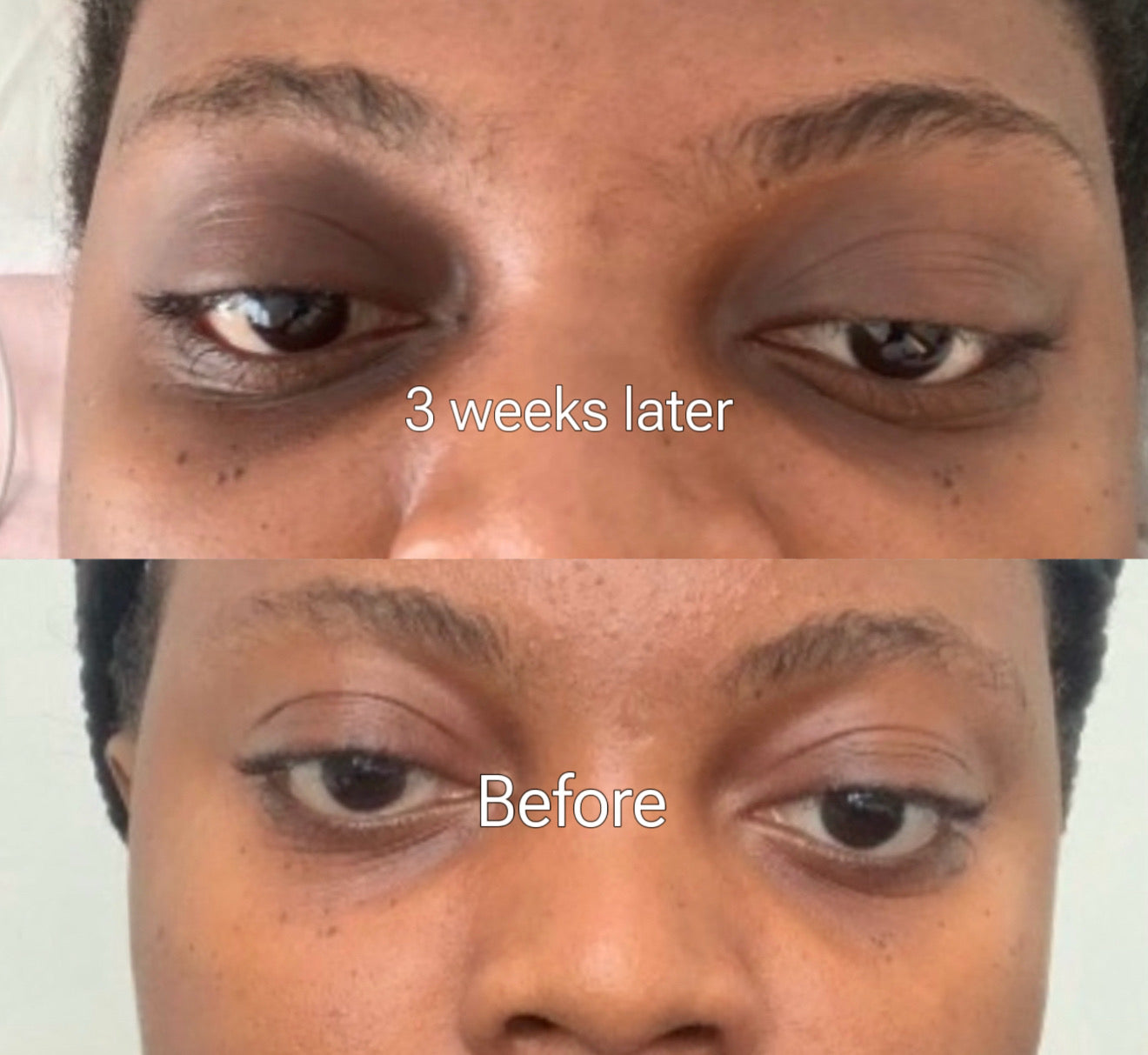 Dark Circle Treatment