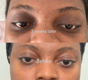 Dark Circle Treatment